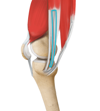 ACL Reconstruction Hamstring Tendon