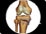Knee Arthritis (Diagramatic And Xray)
