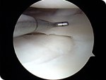 LATERAL MENISCUS