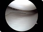 MEDIAL MENISCUS