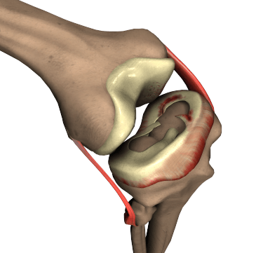 Meniscus Tear