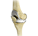 Total Knee Replacement (TKR)